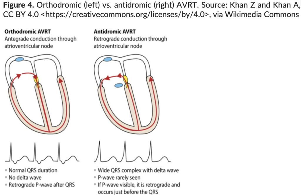Figure 4. Orthodromic vs. Antidromic AVRT.